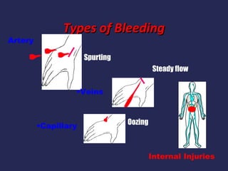 Artery

Types of Bleeding
Spurting
Steady flow
•Veins

•Capillary

Oozing

Internal Injuries

 