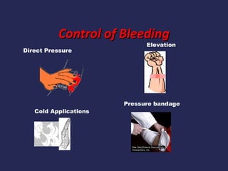 Control of Bleeding
Direct Pressure

Cold Applications

Elevation

Pressure bandage

 