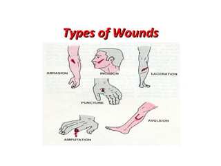Types of Wounds

 