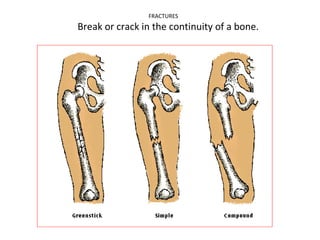 FRACTURES

Break or crack in the continuity of a bone.

 