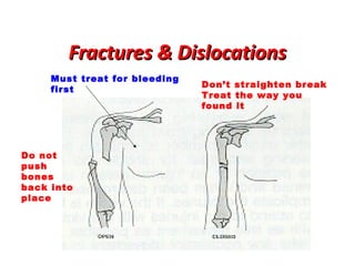 Fractures & Dislocations
Must treat for bleeding
first

Do not
push
bones
back into
place

Don’t straighten break
Treat the way you
found it

 