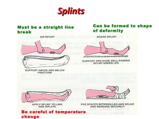 Splints
Must be a straight line
break

Be careful of temperature
change

Can be formed to shape
of deformity

 