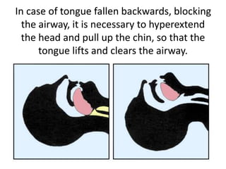 In case of tongue fallen backwards, blocking
the airway, it is necessary to hyperextend
the head and pull up the chin, so that the
tongue lifts and clears the airway.
 