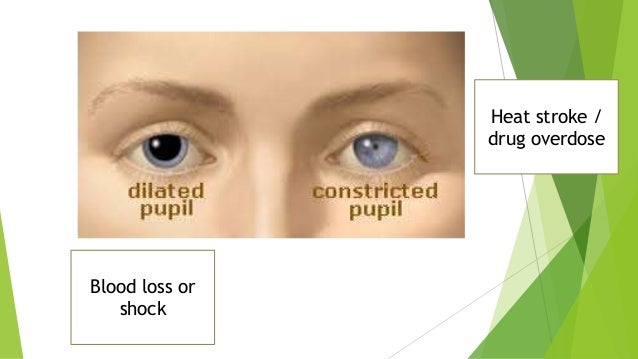 constricted pupil size constricted pupil size