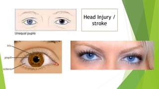 Head Injury /
stroke
 