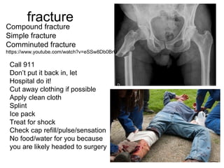 fracture
Compound fracture
Simple fracture
Comminuted fracture
https://www.youtube.com/watch?v=eSSw8Db0BrU
Call 911
Don’t put it back in, let
Hospital do it!
Cut away clothing if possible
Apply clean cloth
Splint
Ice pack
Treat for shock
Check cap refill/pulse/sensation
No food/water for you because
you are likely headed to surgery
 