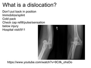 What is a dislocation?
Don’t put back in position
Immobilize/splint
Cold pack
Check cap refill/pulse/sensation
below injury
Hospital visit/911
https://www.youtube.com/watch?v=9Cifk_ohsDo
 