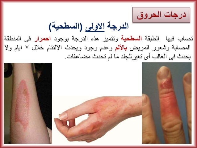 مبادئ الإسعافات الأولية First-aid-illustrated-simplified-14-638