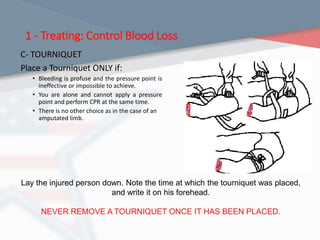 1 - Treating: Control Blood Loss
C- TOURNIQUET
Place a Tourniquet ONLY if:
• Bleeding is profuse and the pressure point is
ineffective or impossible to achieve.
• You are alone and cannot apply a pressure
point and perform CPR at the same time.
• There is no other choice as in the case of an
amputated limb.
Lay the injured person down. Note the time at which the tourniquet was placed,
and write it on his forehead.
NEVER REMOVE A TOURNIQUET ONCE IT HAS BEEN PLACED.
 