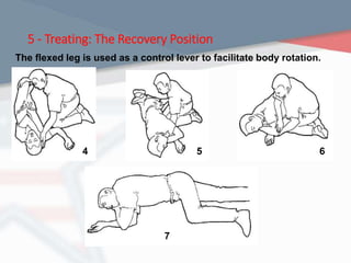 5 - Treating: The Recovery Position
The flexed leg is used as a control lever to facilitate body rotation.
4 5 6
7
 