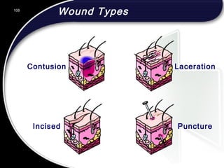 108
Wound Types
LacerationContusion
Incised Puncture
108
© 2002 Abertay Nationwide Training
 