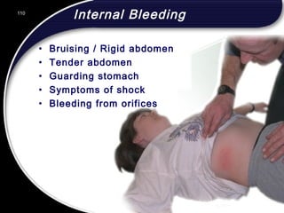 110
Internal Bleeding
• Bruising / Rigid abdomen
• Tender abdomen
• Guarding stomach
• Symptoms of shock
• Bleeding from orifices
110
© 2002 Abertay Nationwide Training
 