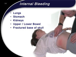 111
Internal Bleeding
• Lungs
• Stomach
• Kidneys
• Upper / Lower Bowel
• Fractured base of skull
111
© 2002 Abertay Nationwide Training
 