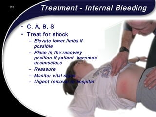 112
Treatment - Internal Bleeding
• C, A, B, S
• Treat for shock
– Elevate lower limbs if
possible
– Place in the recovery
position if patient becomes
unconscious
– Reassure
– Monitor vital signs
– Urgent removal to hospital
112
© 2002 Abertay Nationwide Training
 