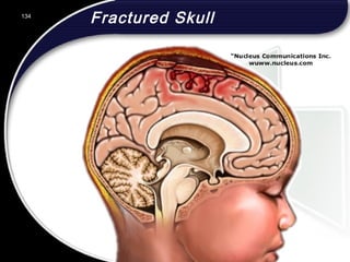134
Fractured Skull134
© 2002 Abertay Nationwide Training
 
