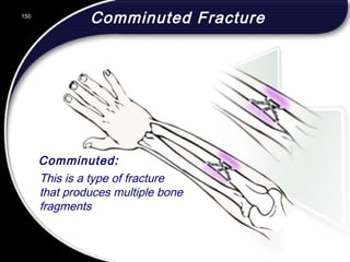 150
Comminuted:
This is a type of fracture
that produces multiple bone
fragments
Comminuted Fracture150
© 2002 Abertay Nationwide Training
 
