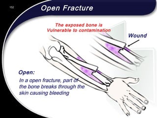 152
Open:
In a open fracture, part of
the bone breaks through the
skin causing bleeding
The exposed bone is
Vulnerable to contamination
Wound
Open Fracture152
© 2002 Abertay Nationwide Training
 