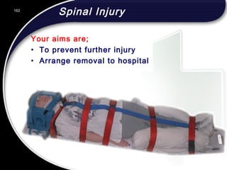 162
Spinal Injury
Your aims are;
• To prevent further injury
• Arrange removal to hospital
162
© 2002 Abertay Nationwide Training
 