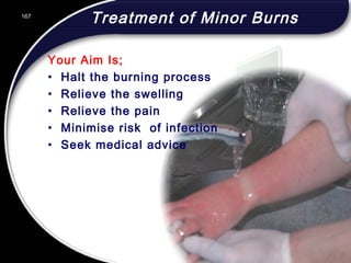 167
Treatment of Minor Burns
Your Aim Is;
• Halt the burning process
• Relieve the swelling
• Relieve the pain
• Minimise risk of infection
• Seek medical advice
167
© 2002 Abertay Nationwide Training
 