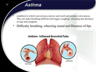 Asthma
• condition in which your airways narrow and swell and produce extra mucus.
This can make breathing difficult and trigger coughing, wheezing and shortness
of sign and symptom
• Difficulty breathing, wheezing sound and Blueness of lips
80
 