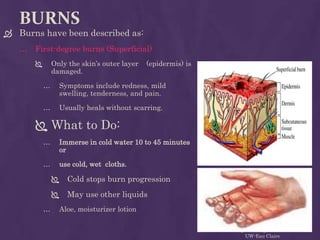 Slight Burn In First aid | PPTX