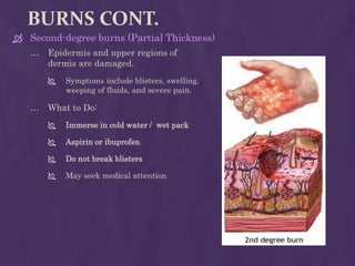 BURNS CONT.
 Second-degree burns (Partial Thickness)
… Epidermis and upper regions of
dermis are damaged.
 Symptoms include blisters, swelling,
weeping of fluids, and severe pain.
… What to Do:
 Immerse in cold water / wet pack
 Aspirin or ibuprofen
 Do not break blisters
 May seek medical attention
 