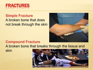 FRACTURES
Simple Fracture
A broken bone that does
not break through the skin
Compound Fracture
A broken bone that breaks through the tissue and
skin
 