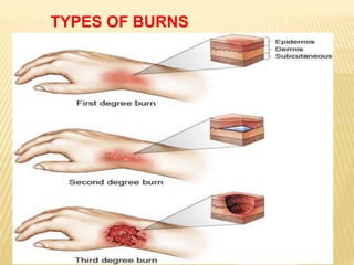 TYPES OF BURNS
 