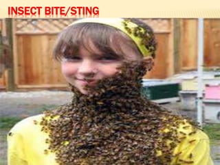 INSECT BITE/STING
 