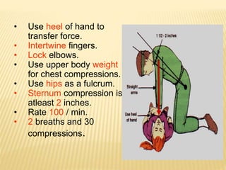 • Use heel of hand to
transfer force.
• Intertwine fingers.
• Lock elbows.
• Use upper body weight
for chest compressions.
• Use hips as a fulcrum.
• Sternum compression is
atleast 2 inches.
• Rate 100 / min.
• 2 breaths and 30
compressions.
 