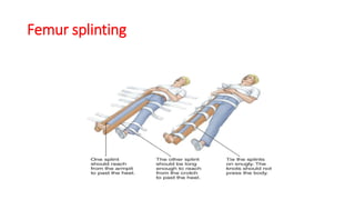 Femula Fracture first aid by Dr. Hany Aldakar MD. Orthopedic Surgery and ...