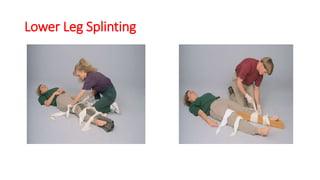 Splinter Injury Leg Fracture first aid by Dr. Hany Aldakar MD. Orthopedic Surgery and ...
