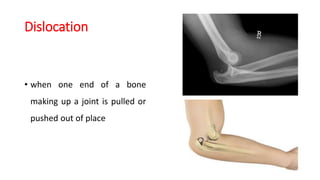 Tow Dislocation Fracture first aid by Dr. Hany Aldakar MD. Orthopedic Surgery and ...