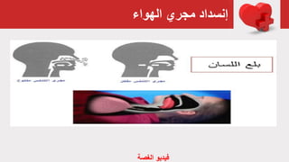 ‫الهواء‬ ‫مجري‬ ‫إنسداد‬
‫الغص‬ ‫فيديو‬‫ة‬
 