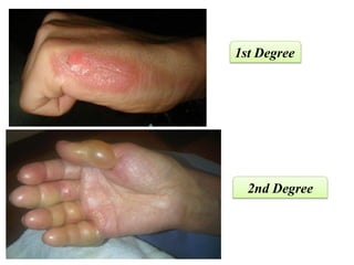 1st Degree
2nd Degree
 