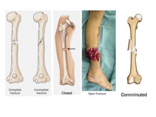 Open Fracture
 