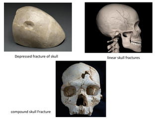 linear skull fractures
Depressed fracture of skull
compound skull Fracture
 