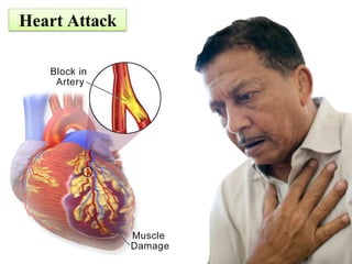 Heart Attack
 