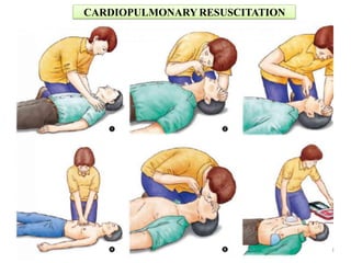 CARDIOPULMONARY RESUSCITATION
 