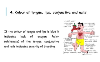 If the colour of tongue and lips is blue it
indicates lack of oxygen. Pallor
(whiteness) of the tongue, conjunctiva
and nails indicates severity of bleeding.
4. Colour of tongue, lips, conjunctiva and nails:
 