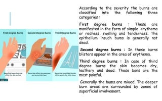 According to the severity the burns are
classified into the following three
categories :
First degree burns : These are
manifested in the form of simple erythema
or redness, swelling and tenderness. The
epithelium insuch bums is generally not
dead.
Second degree burns : In these burns
blisters appear in the area of erythema.
Third degree burns : In case of third
degree burns the skin becomes dry,
leathery and dead. These bons are the
most painful.
Generally the bums are mixed. The deeper
burn areas are surrounded by zones of
superficial involvement.
 