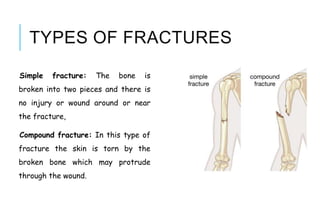 TYPES OF FRACTURES
Simple fracture: The bone is
broken into two pieces and there is
no injury or wound around or near
the fracture,
Compound fracture: In this type of
fracture the skin is torn by the
broken bone which may protrude
through the wound.
 