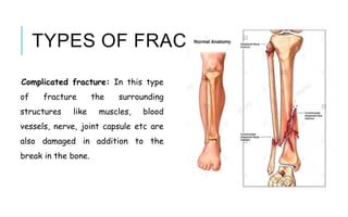 TYPES OF FRACTURES
Complicated fracture: In this type
of fracture the surrounding
structures like muscles, blood
vessels, nerve, joint capsule etc are
also damaged in addition to the
break in the bone.
 