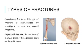 TYPES OF FRACTURES
Comminuted fracture: This type of
fracture is characterized by
breaking of a bone into several
fragments.
Depressed fracture: In this type of
injury, a piece of bone pressed down
on the soft tissue.
Comminuted fracture Depressed fracture
 
