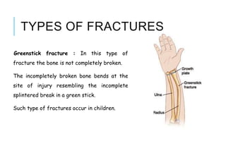 TYPES OF FRACTURES
Greenstick fracture : In this type of
fracture the bone is not completely broken.
The incompletely broken bone bends at the
site of injury resembling the incomplete
splintered break in a green stick.
Such type of fractures occur in children.
 