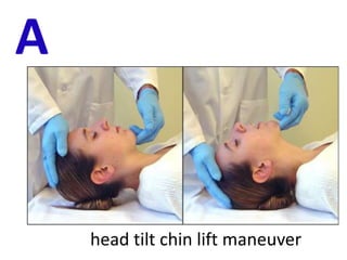 A
head tilt chin lift maneuver
 