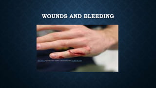 WOUNDS AND BLEEDING
This Photo by Unknown Author is licensed under CC BY-NC-ND
 
