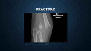 FRACTURE
This Photo by Unknown Author is licensed under CC BY-SA
 