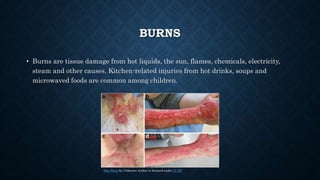 BURNS
• Burns are tissue damage from hot liquids, the sun, flames, chemicals, electricity,
steam and other causes. Kitchen-related injuries from hot drinks, soups and
microwaved foods are common among children.
This Photo by Unknown Author is licensed under CC BY
 