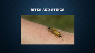 BITES AND STINGS
 